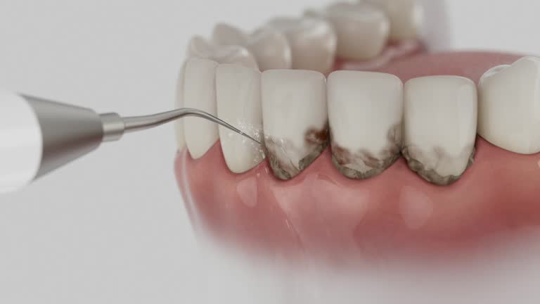 Trusted Wisdom Tooth Removal service in Three Lakes, FL - Dentist Open Now
